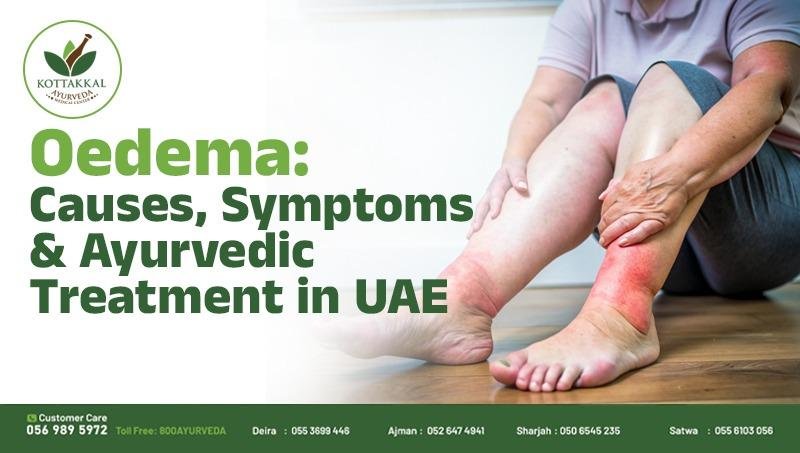 OEDEMA Causes, Symptoms, and the Best Ayurvedic Treatment in the UAE