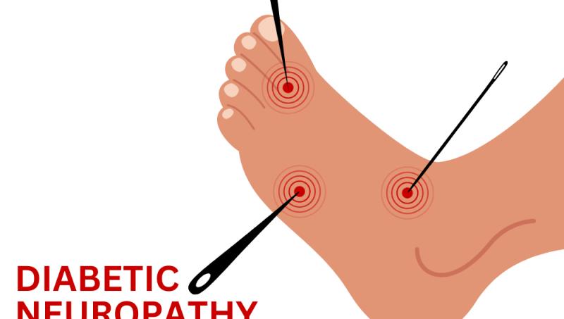 Diabetic Neuropathy