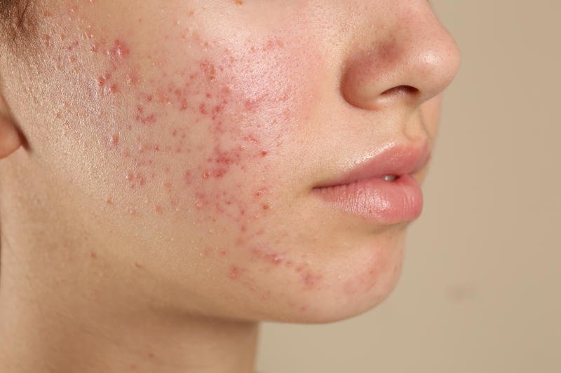 Acne Treatment