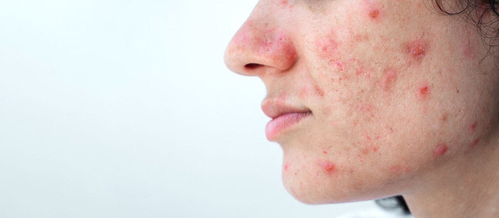 Acne Treatment