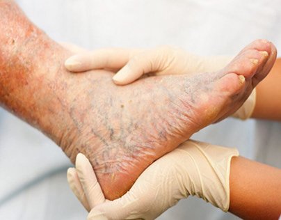 Varicose Veins Treatments