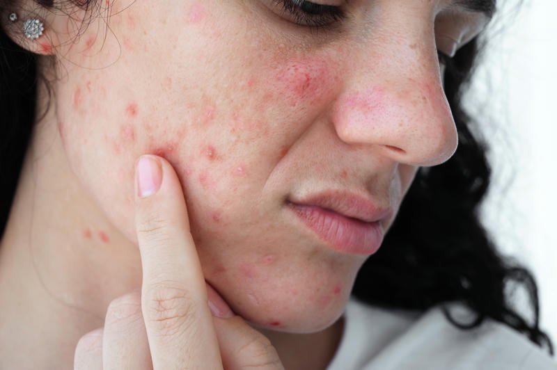 Acne Treatment