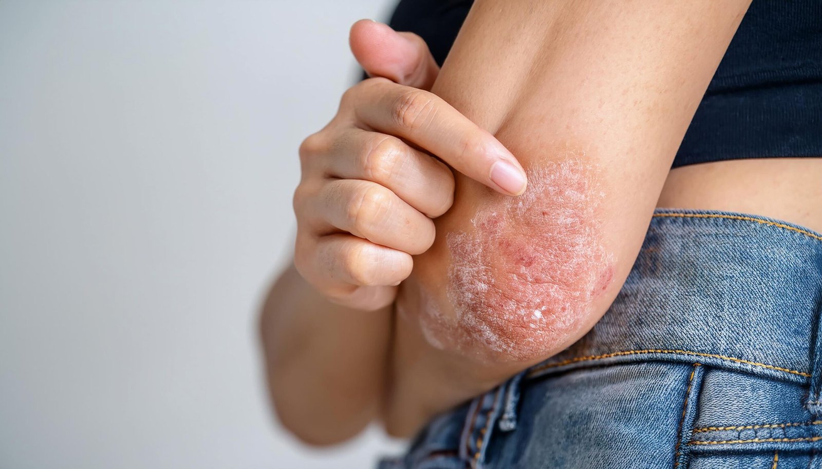 Ayurvedic Treatment for Psoriasis