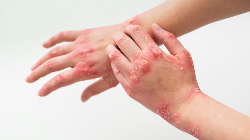 Ayurvedic Treatment for Psoriasis